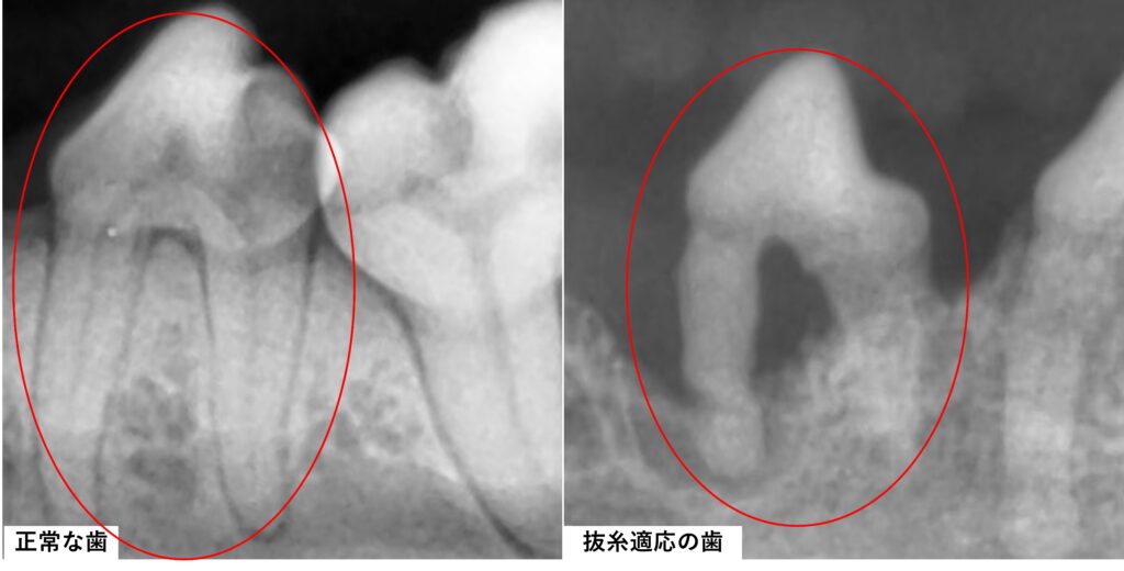 正常な歯と抜歯適応の歯の違い